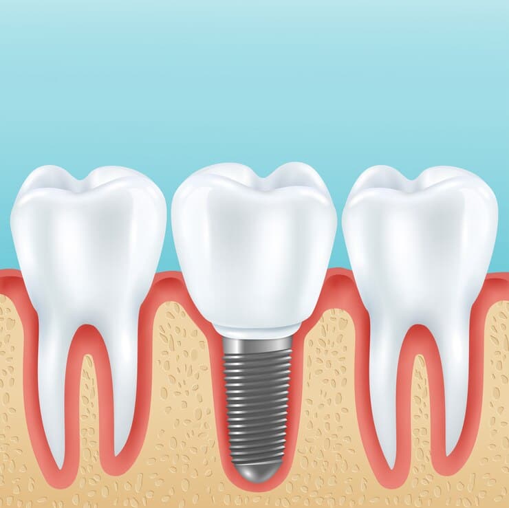Oral Implant